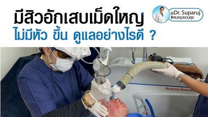 มีสิวอักเสบเม็ดใหญ่ ไม่มีหัว ขึ้น ดูแลอย่างไรดี ?